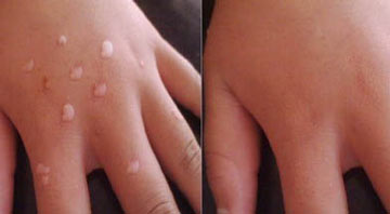 广州肤康皮肤病医院