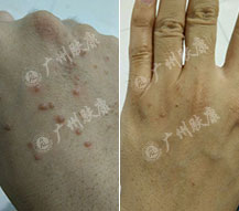 广州肤康皮肤病医院